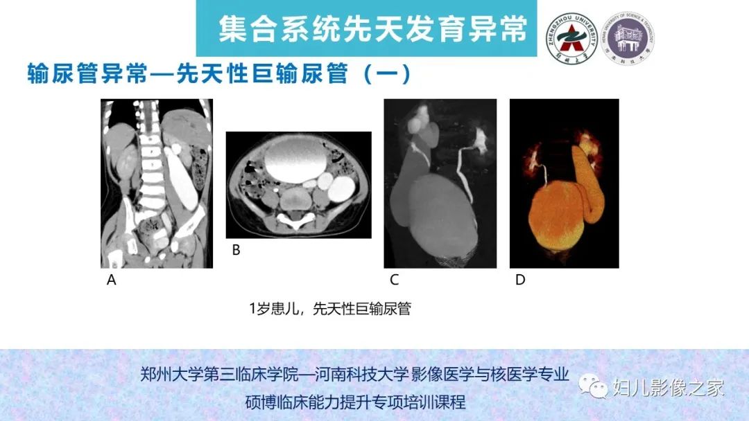 影像PPT - 【PPT】泌尿系先天性发育畸形的影像诊断-50