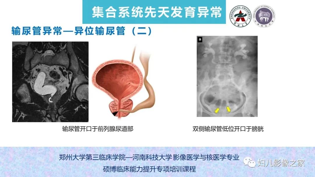 影像PPT - 【PPT】泌尿系先天性发育畸形的影像诊断-52