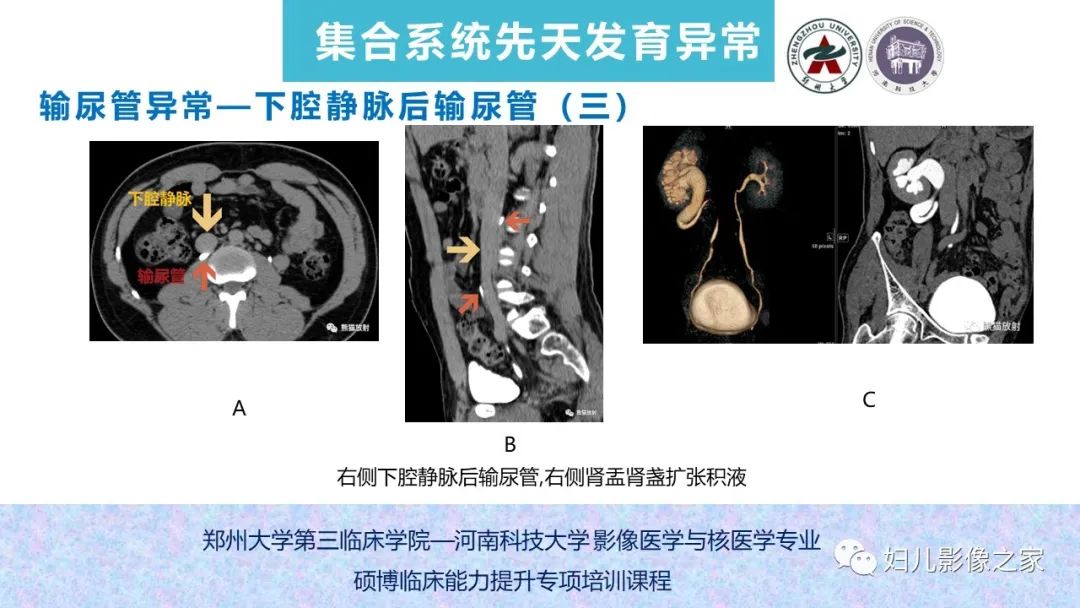 影像PPT - 【PPT】泌尿系先天性发育畸形的影像诊断-54