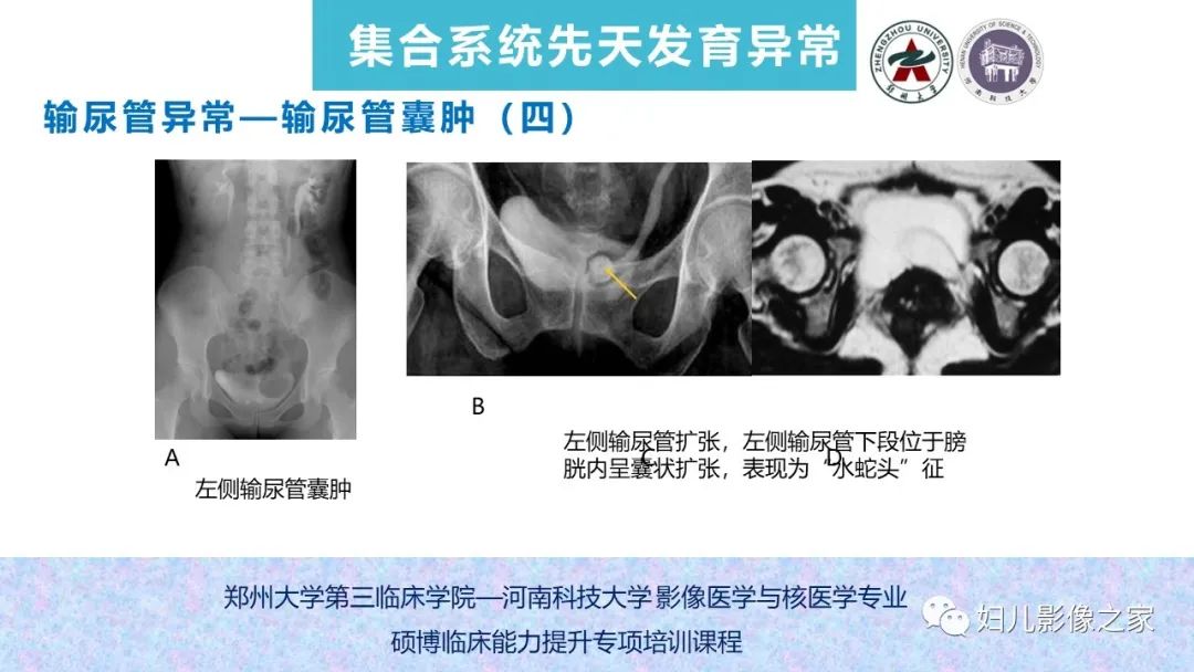 影像PPT - 【PPT】泌尿系先天性发育畸形的影像诊断-56
