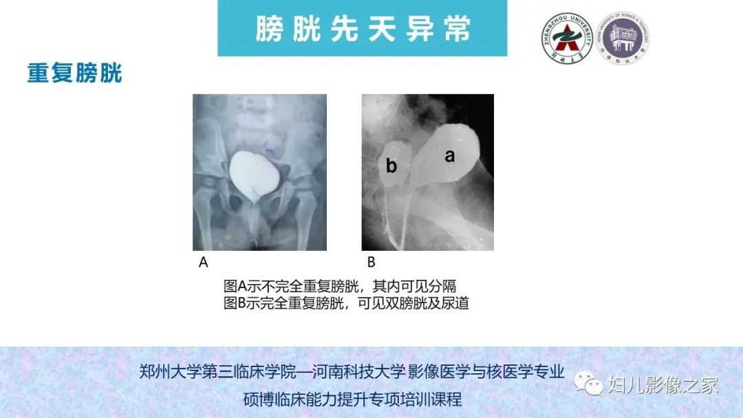 影像PPT - 【PPT】泌尿系先天性发育畸形的影像诊断-59