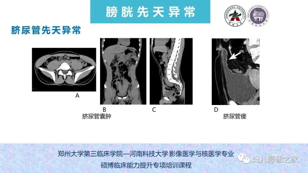 影像PPT - 【PPT】泌尿系先天性发育畸形的影像诊断-61