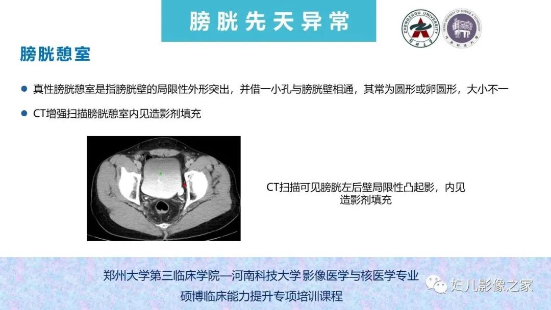 影像PPT - 【PPT】泌尿系先天性发育畸形的影像诊断-62