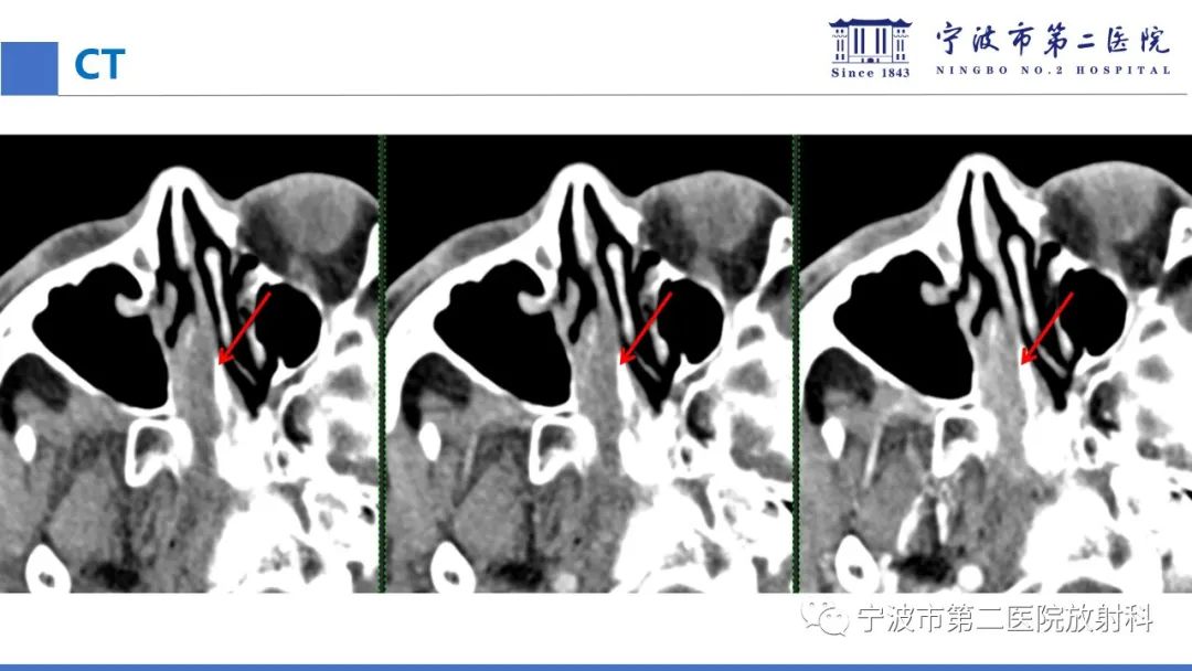 影像PPT - 【PPT】嗅神经母细胞瘤-9
