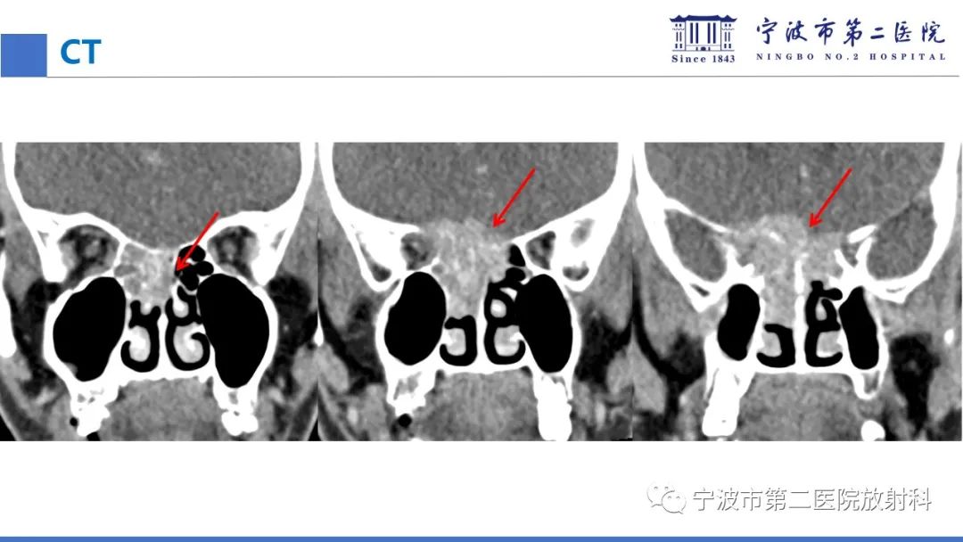 影像PPT - 【PPT】嗅神经母细胞瘤-10
