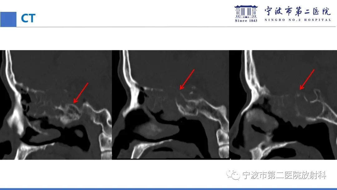 影像PPT - 【PPT】嗅神经母细胞瘤-14