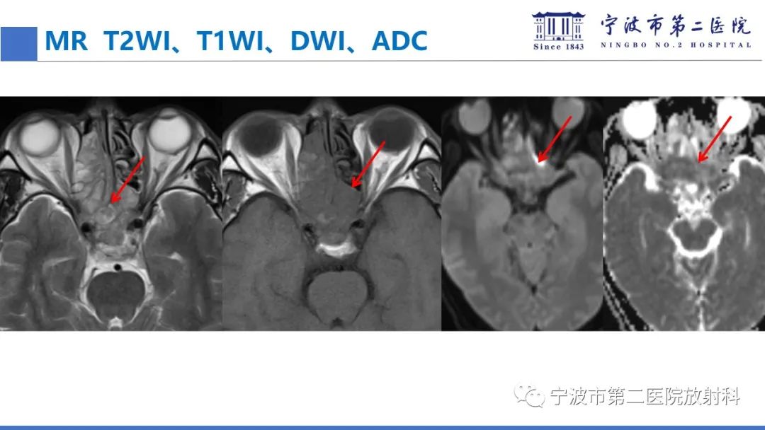影像PPT - 【PPT】嗅神经母细胞瘤-15