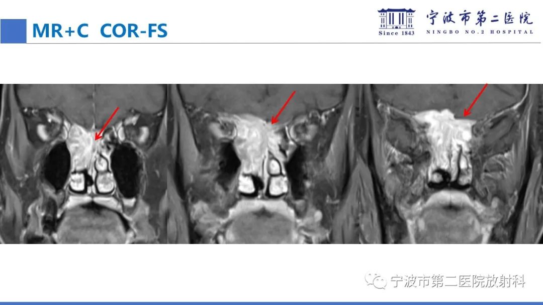影像PPT - 【PPT】嗅神经母细胞瘤-17