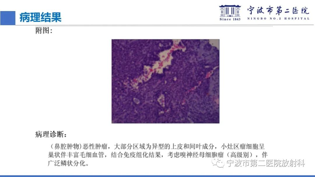 影像PPT - 【PPT】嗅神经母细胞瘤-25