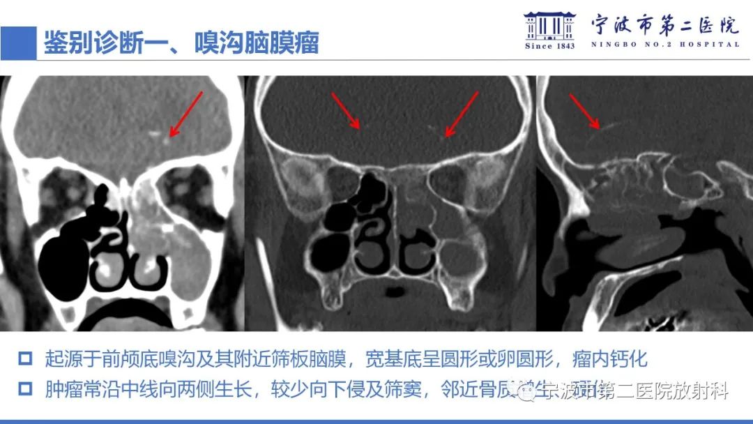 影像PPT - 【PPT】嗅神经母细胞瘤-34