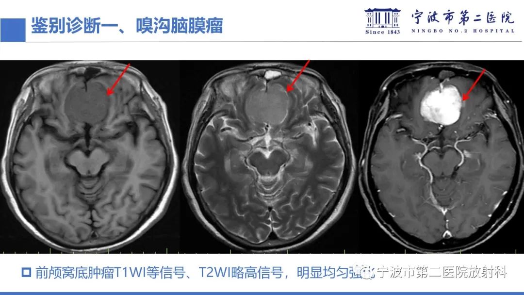 影像PPT - 【PPT】嗅神经母细胞瘤-35