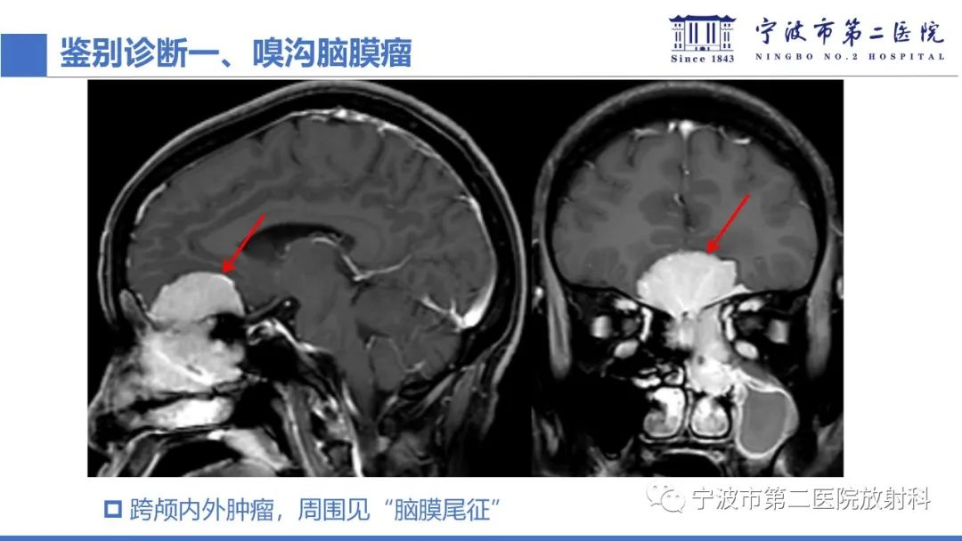 影像PPT - 【PPT】嗅神经母细胞瘤-36