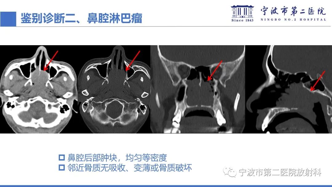 影像PPT - 【PPT】嗅神经母细胞瘤-38