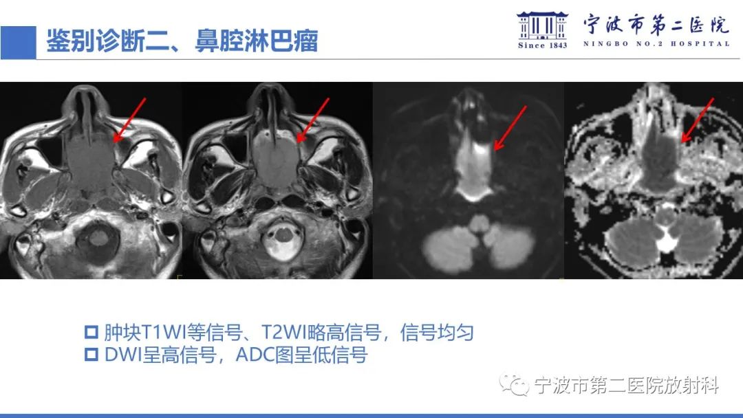 影像PPT - 【PPT】嗅神经母细胞瘤-39