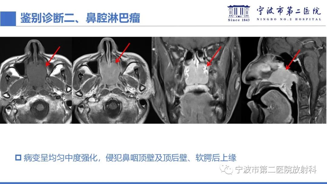 影像PPT - 【PPT】嗅神经母细胞瘤-40
