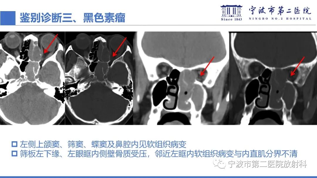 影像PPT - 【PPT】嗅神经母细胞瘤-42