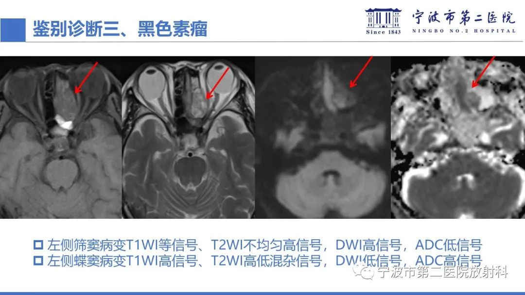 影像PPT - 【PPT】嗅神经母细胞瘤-43