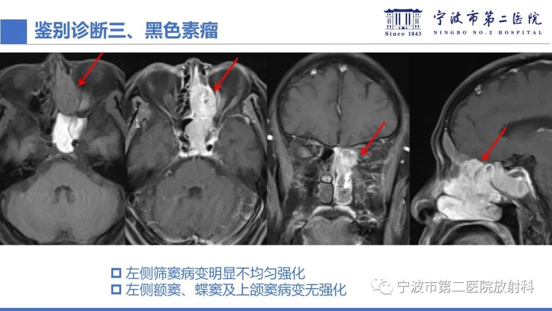 影像PPT - 【PPT】嗅神经母细胞瘤-44