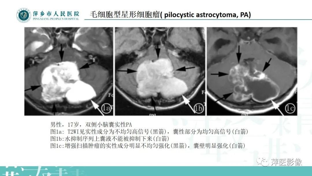 影像PPT - 【PPT】浅谈局限性星形细胞瘤-10