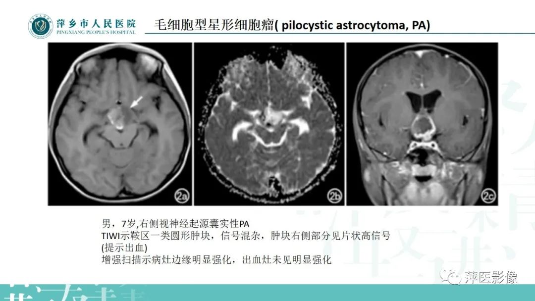 影像PPT - 【PPT】浅谈局限性星形细胞瘤-11
