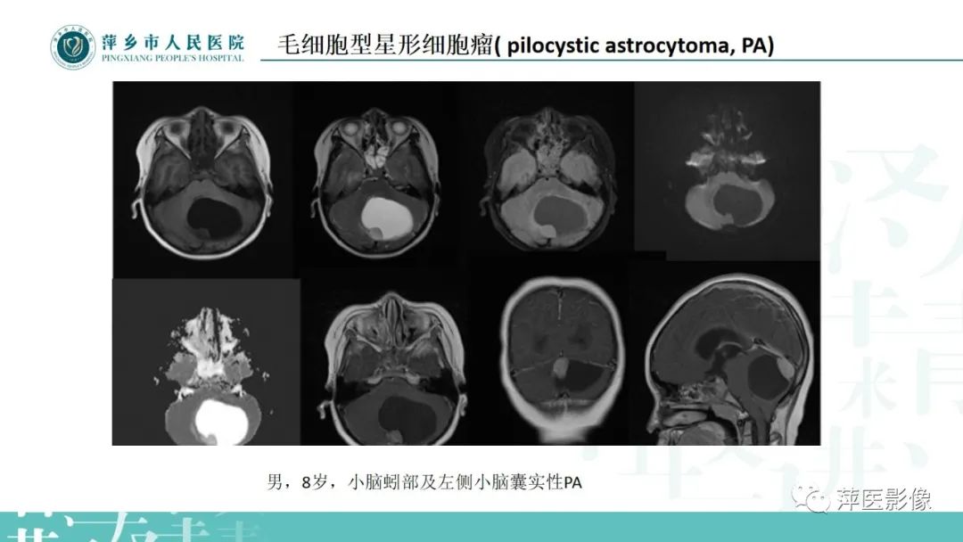 影像PPT - 【PPT】浅谈局限性星形细胞瘤-12
