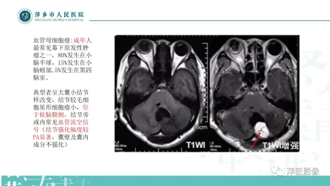 影像PPT - 【PPT】浅谈局限性星形细胞瘤-15