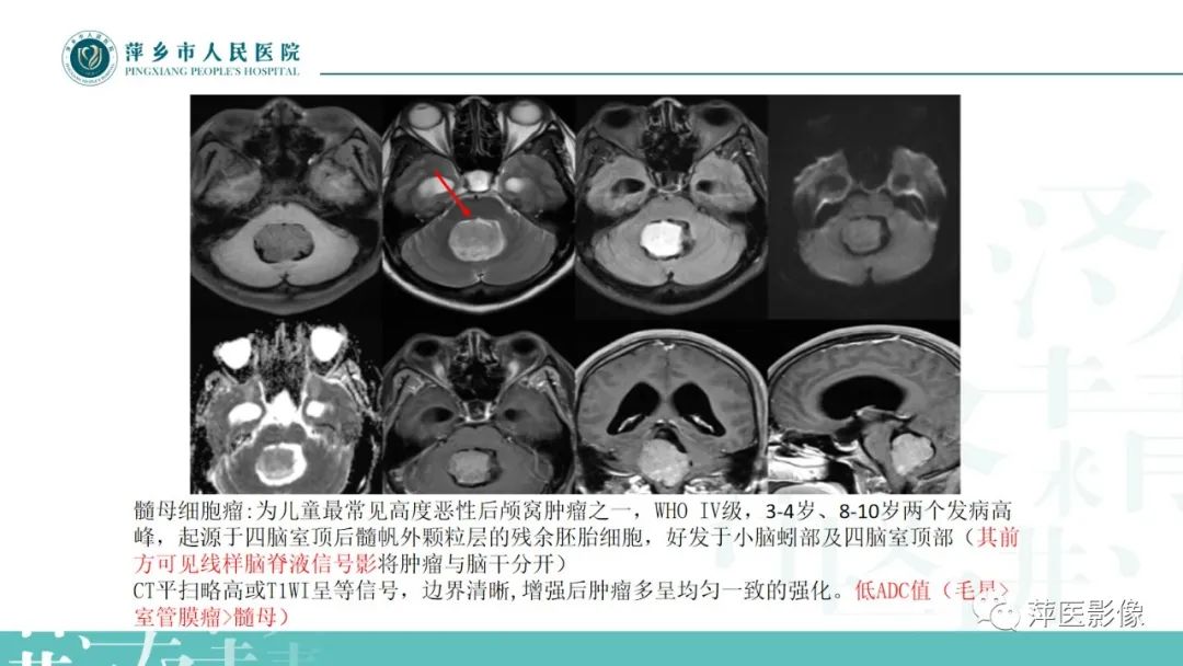 影像PPT - 【PPT】浅谈局限性星形细胞瘤-14