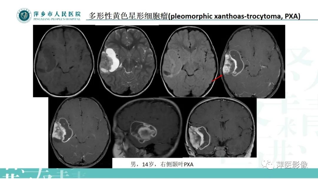 影像PPT - 【PPT】浅谈局限性星形细胞瘤-19
