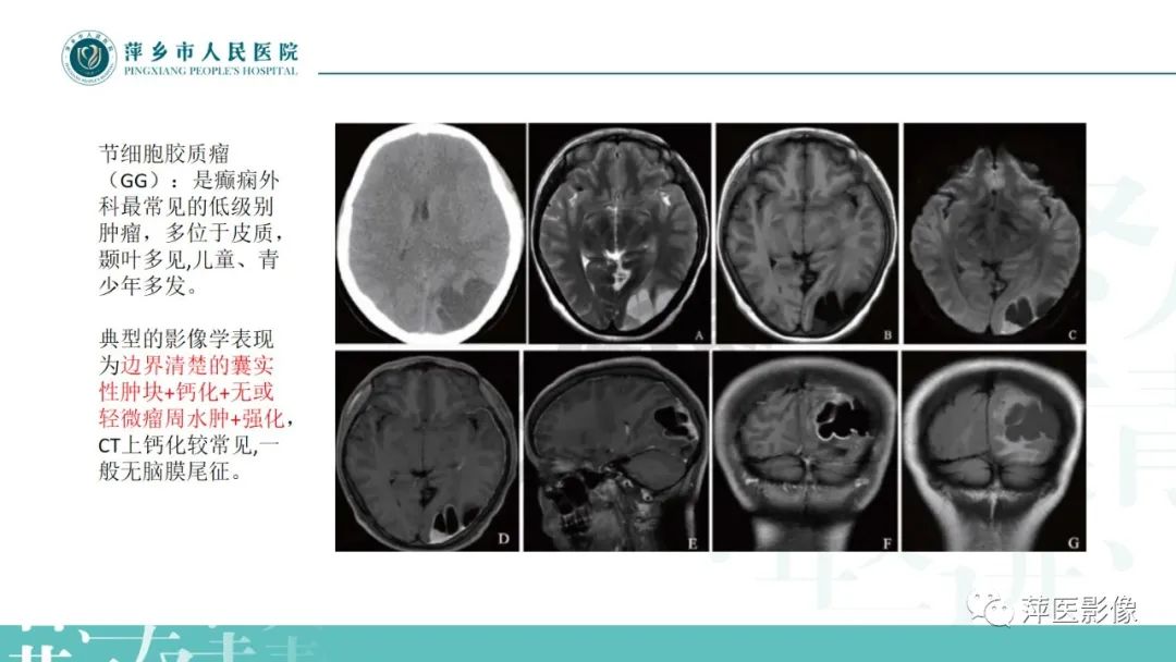 影像PPT - 【PPT】浅谈局限性星形细胞瘤-21