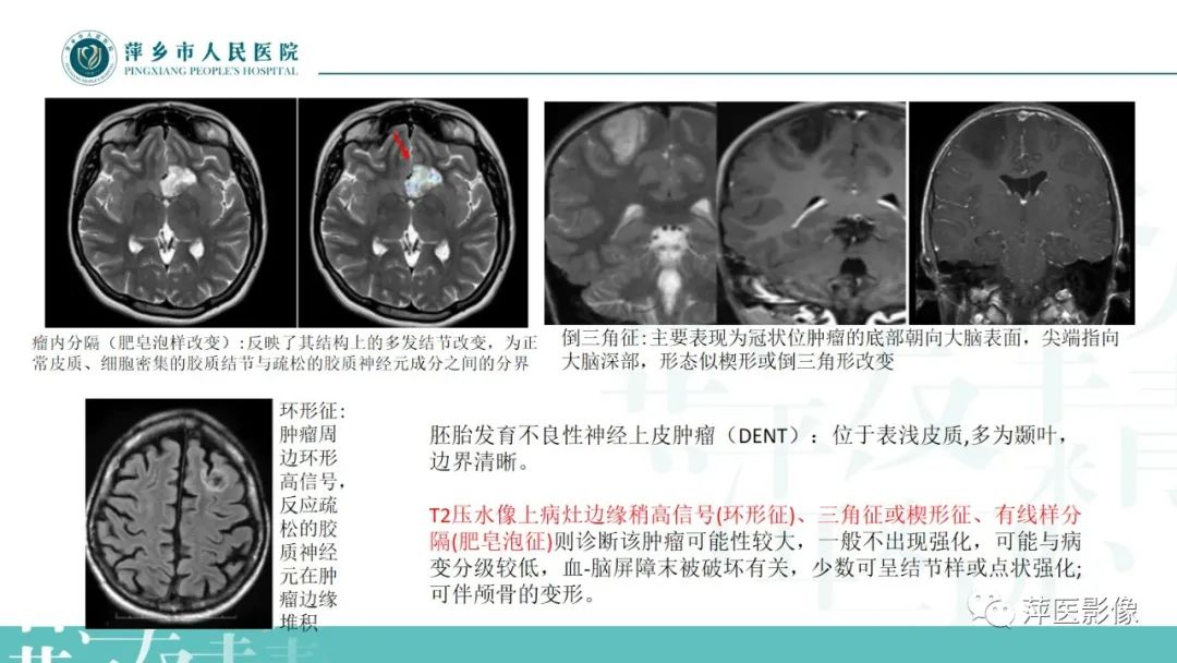 影像PPT - 【PPT】浅谈局限性星形细胞瘤-22