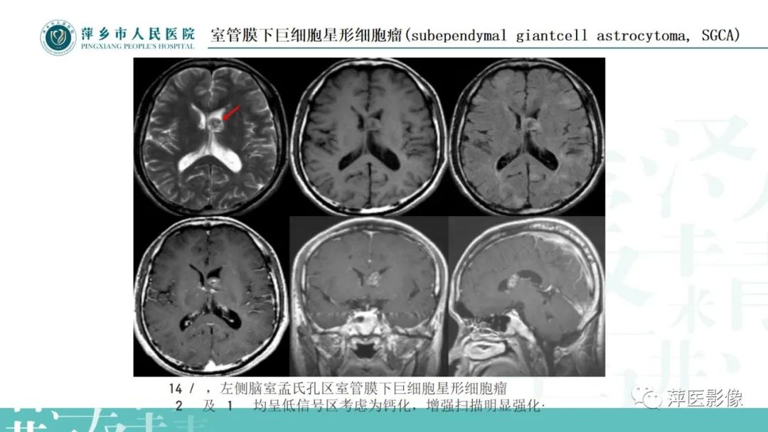 影像PPT - 【PPT】浅谈局限性星形细胞瘤-27
