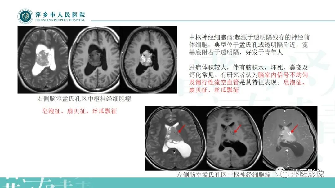 影像PPT - 【PPT】浅谈局限性星形细胞瘤-30