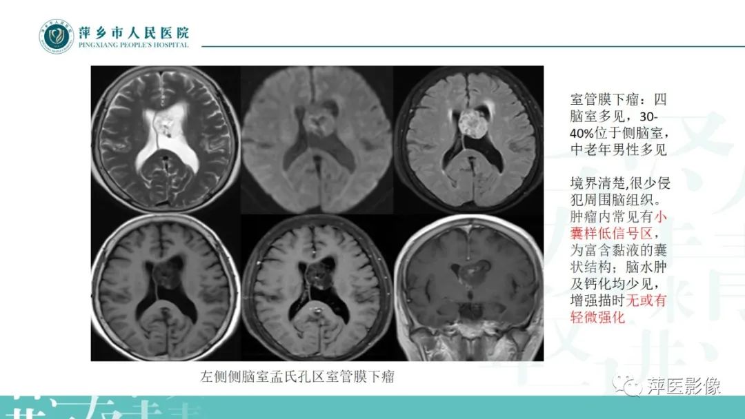 影像PPT - 【PPT】浅谈局限性星形细胞瘤-29