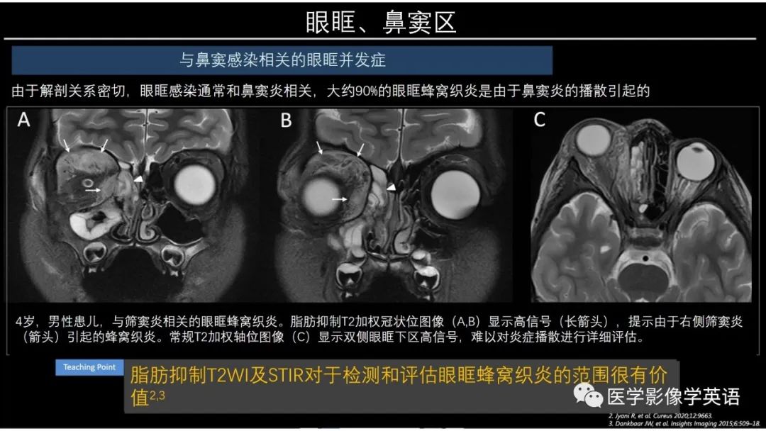 影像PPT - 【PPT】头颈部感染影像学进展-12 影像PPT - 【PPT】头颈部感染影像学进展-12