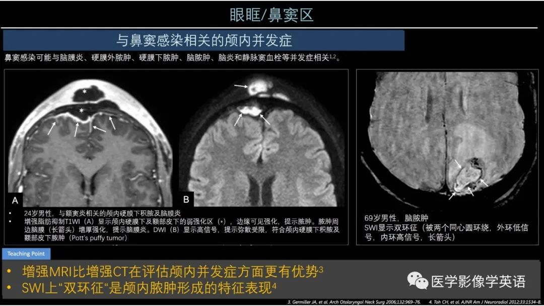 影像PPT - 【PPT】头颈部感染影像学进展-16 影像PPT - 【PPT】头颈部感染影像学进展-16