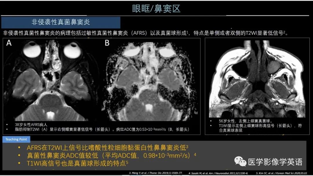 影像PPT - 【PPT】头颈部感染影像学进展-18 影像PPT - 【PPT】头颈部感染影像学进展-18