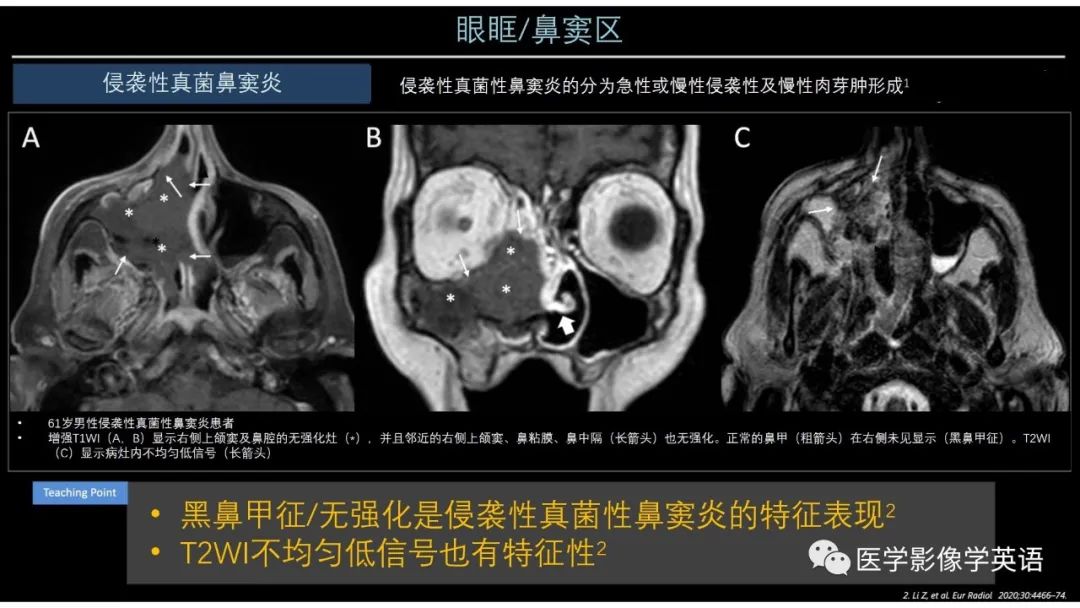 影像PPT - 【PPT】头颈部感染影像学进展-20 影像PPT - 【PPT】头颈部感染影像学进展-20