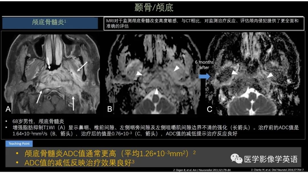 影像PPT - 【PPT】头颈部感染影像学进展-22 影像PPT - 【PPT】头颈部感染影像学进展-22