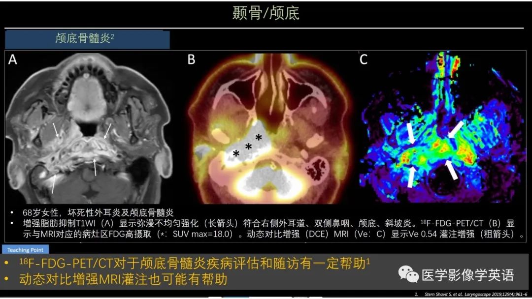 影像PPT - 【PPT】头颈部感染影像学进展-24 影像PPT - 【PPT】头颈部感染影像学进展-24
