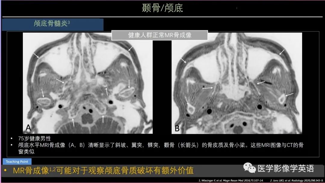 影像PPT - 【PPT】头颈部感染影像学进展-26 影像PPT - 【PPT】头颈部感染影像学进展-26
