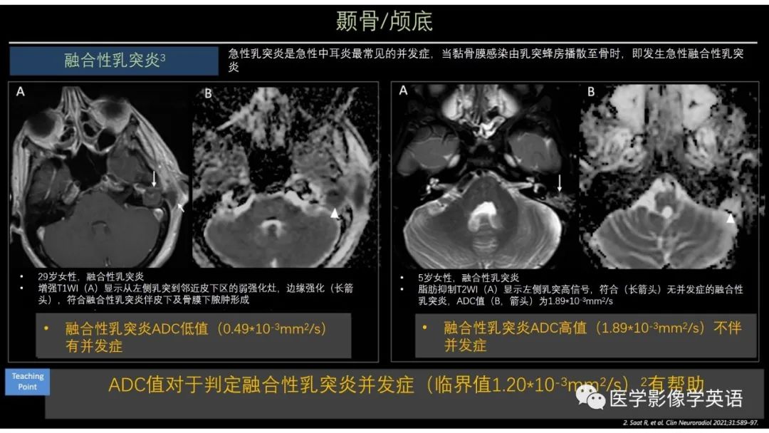 影像PPT - 【PPT】头颈部感染影像学进展-28 影像PPT - 【PPT】头颈部感染影像学进展-28