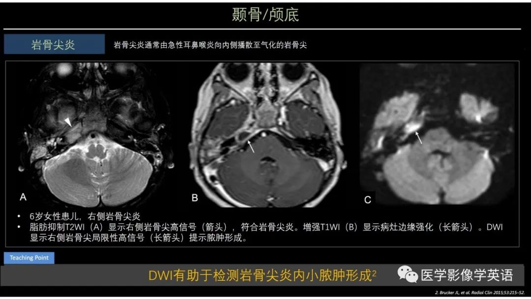 影像PPT - 【PPT】头颈部感染影像学进展-32 影像PPT - 【PPT】头颈部感染影像学进展-32