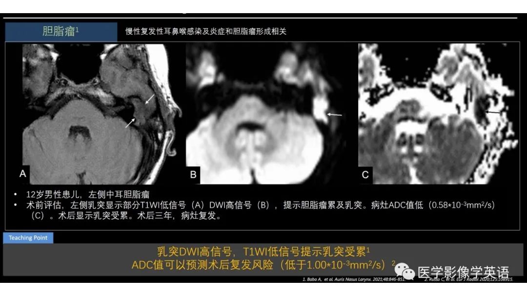 影像PPT - 【PPT】头颈部感染影像学进展-34 影像PPT - 【PPT】头颈部感染影像学进展-34