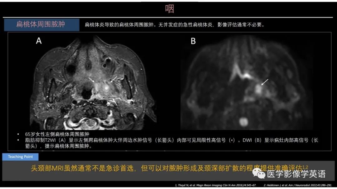 影像PPT - 【PPT】头颈部感染影像学进展-42 影像PPT - 【PPT】头颈部感染影像学进展-42