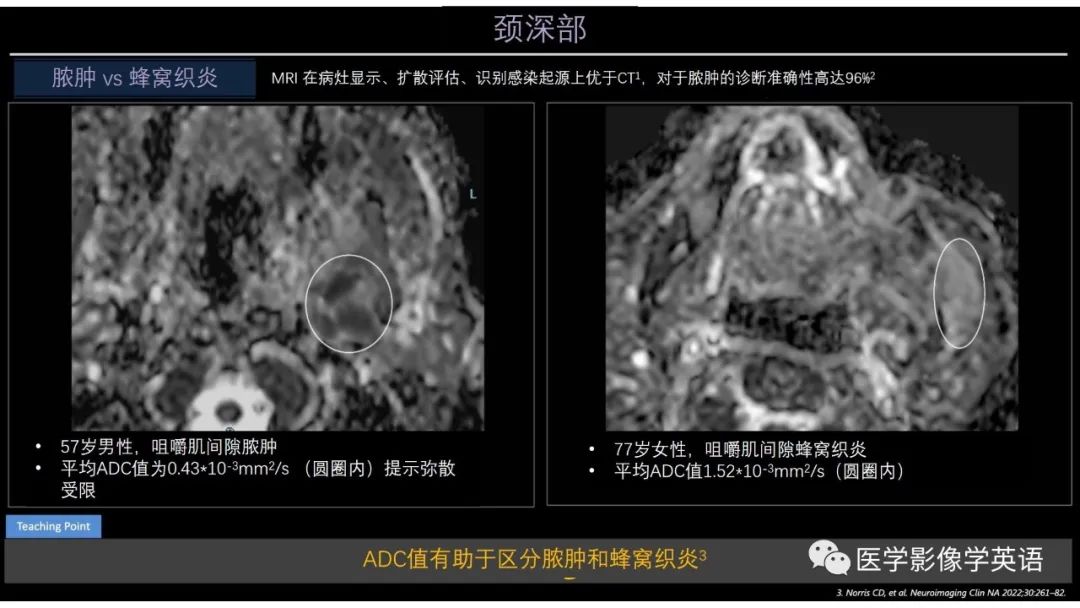 影像PPT - 【PPT】头颈部感染影像学进展-44 影像PPT - 【PPT】头颈部感染影像学进展-44