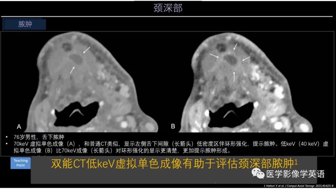 影像PPT - 【PPT】头颈部感染影像学进展-46 影像PPT - 【PPT】头颈部感染影像学进展-46