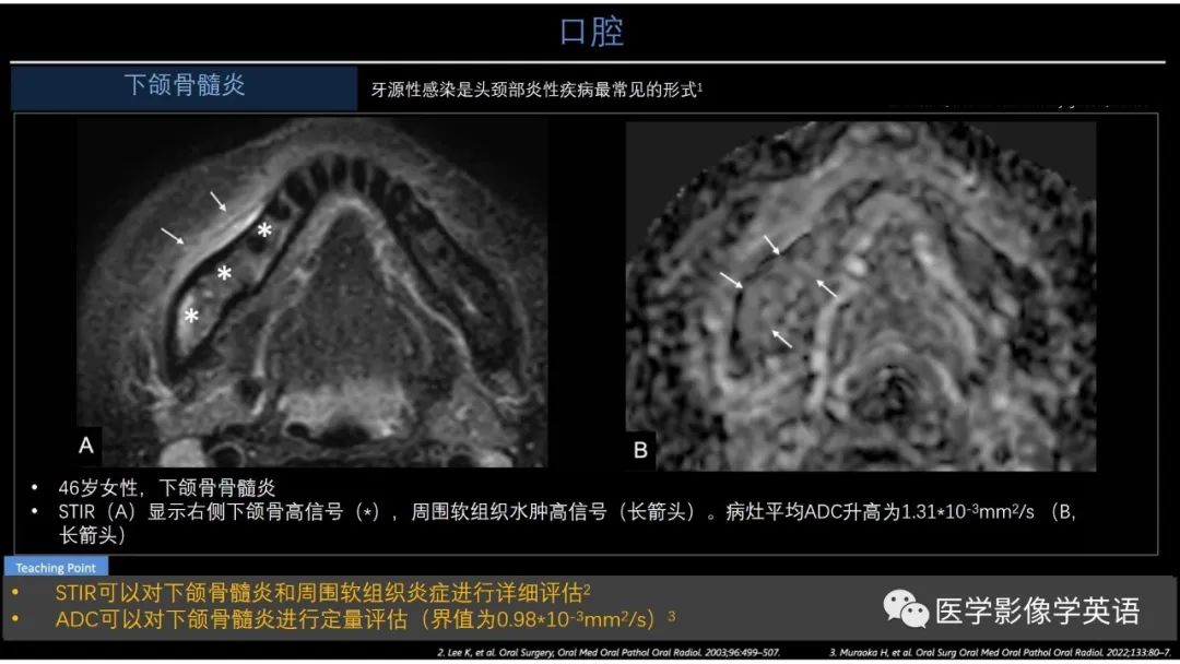 影像PPT - 【PPT】头颈部感染影像学进展-48 影像PPT - 【PPT】头颈部感染影像学进展-48
