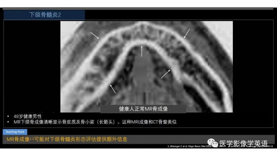 影像PPT - 【PPT】头颈部感染影像学进展-50 影像PPT - 【PPT】头颈部感染影像学进展-50