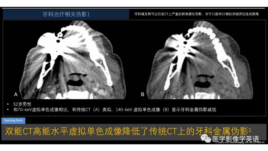影像PPT - 【PPT】头颈部感染影像学进展-52 影像PPT - 【PPT】头颈部感染影像学进展-52