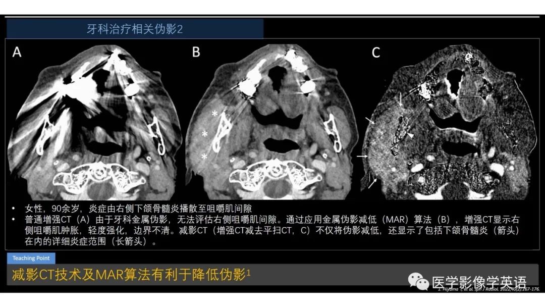 影像PPT - 【PPT】头颈部感染影像学进展-54 影像PPT - 【PPT】头颈部感染影像学进展-54